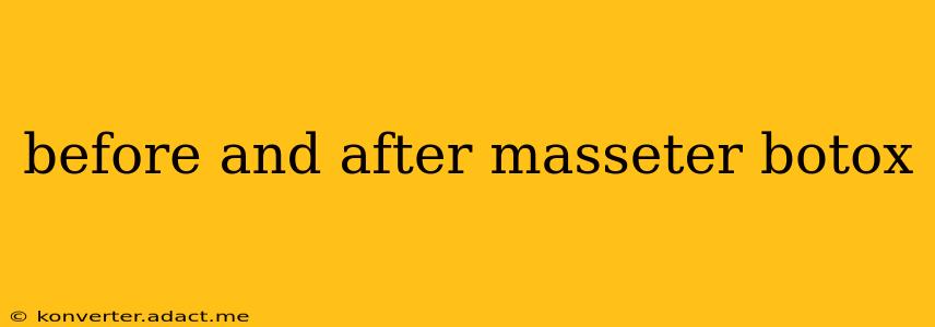 before and after masseter botox