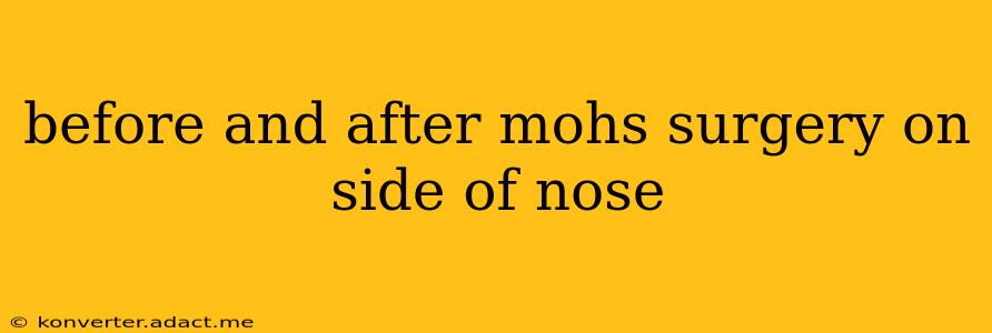 before and after mohs surgery on side of nose