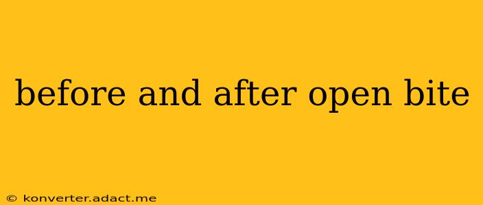 before and after open bite
