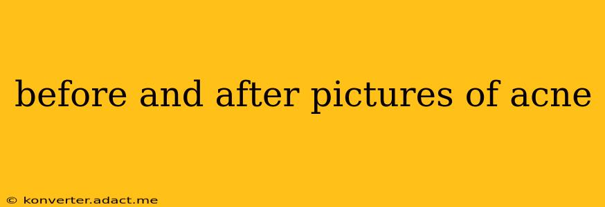 before and after pictures of acne