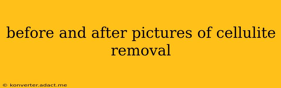 before and after pictures of cellulite removal