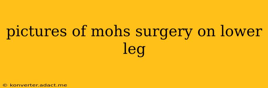 pictures of mohs surgery on lower leg