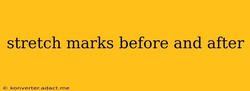 stretch marks before and after