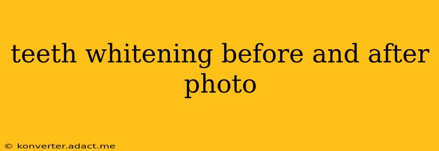 teeth whitening before and after photo