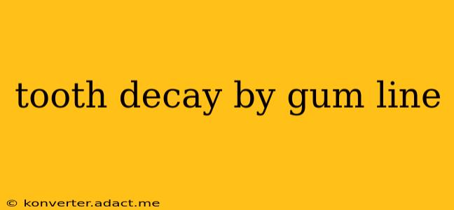tooth decay by gum line
